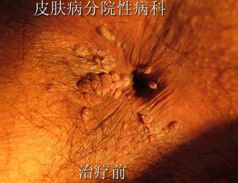 肛周疣_看图王.jpg